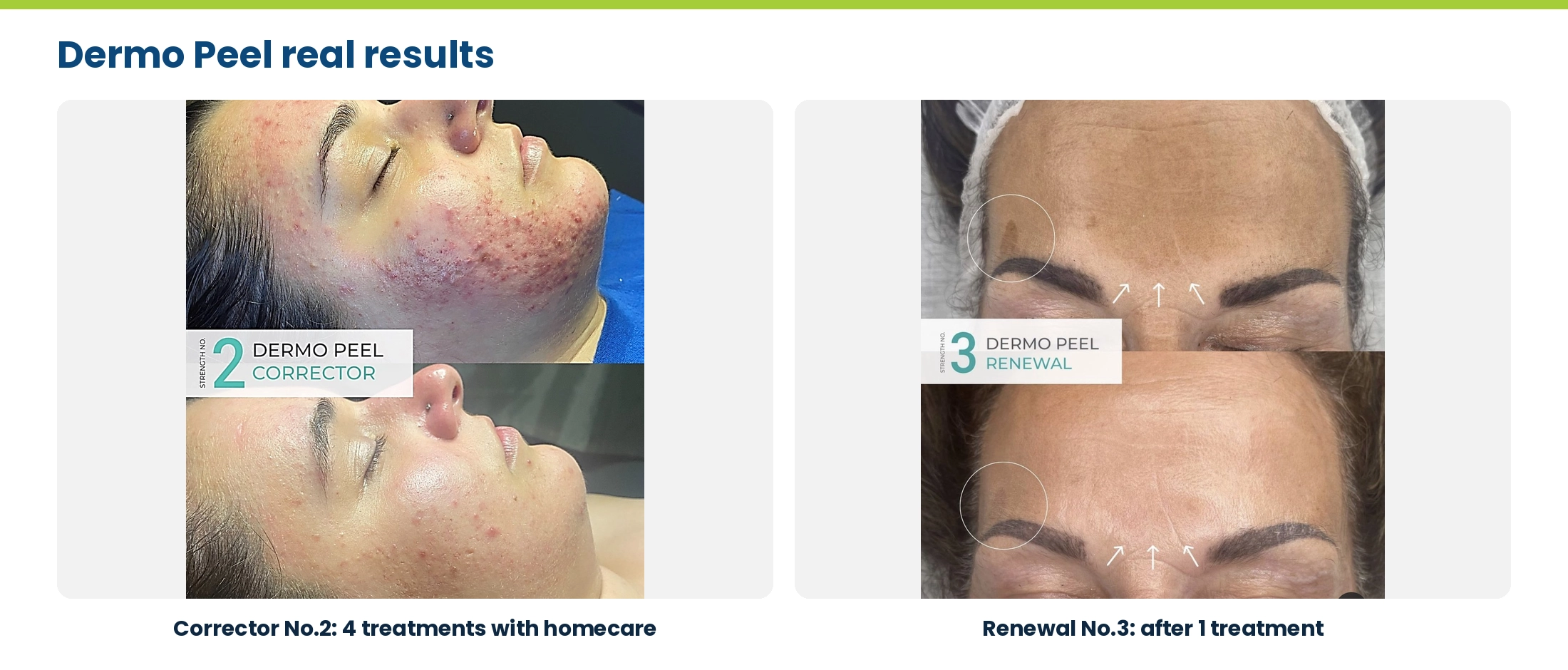 Dermo Peel real results: Corrector No.2 after 4 treatments with homecare, and Renewal No.3 after 1 treatment