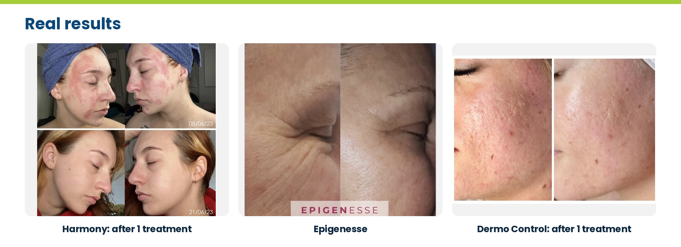 ANESI LAB real results: Harmony after one treatment, Epigenesse, and Dermo Control after one treatment