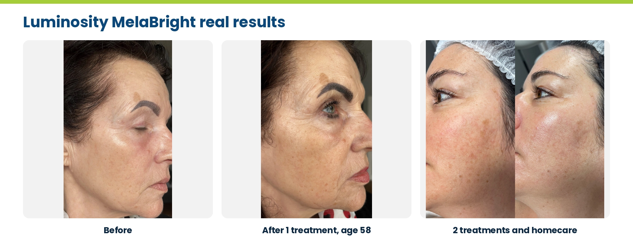 Luminosity MelaBright real results: before and after one treatment at age 58, and after two treatments with homecare